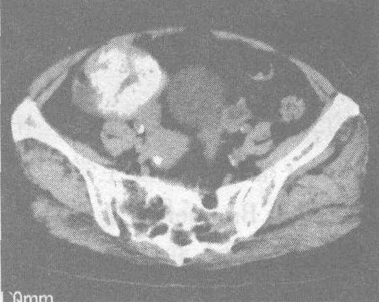双侧卵巢Brenner瘤